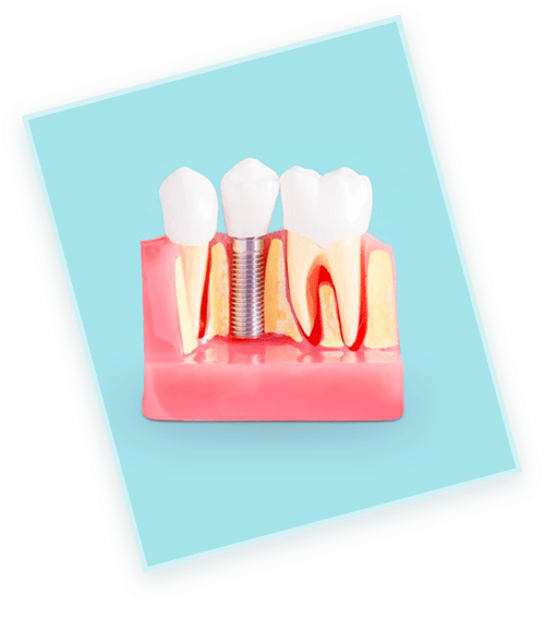 tooth-implants